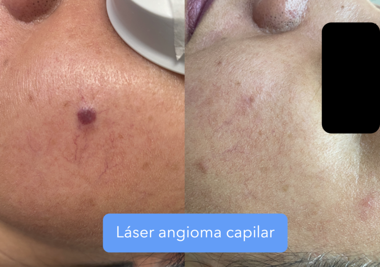 2 sesiones láser Nd: yag